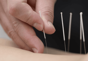 Acupuncture can reduce appendicitis pain in children: Study