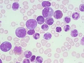 Good News for Bone Marrow Cancer Patients, Targeted Therapies Boosting Results