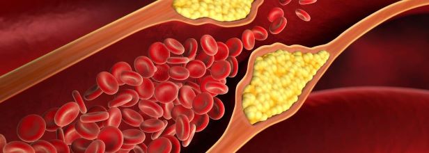 Cholestrol, microplastics, heart diseases, stroke