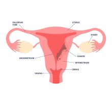 gynaecological cancers, India, Younger Women