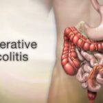 Ulcerative Colitis, Colon Cancer Risk, Gene