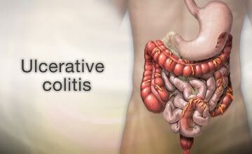 Ulcerative Colitis, Colon Cancer Risk, Gene