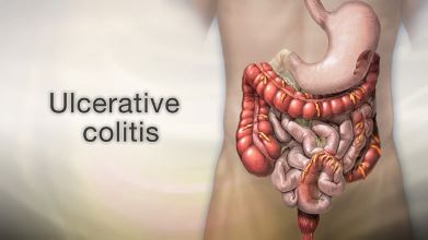 Ulcerative Colitis, Colon Cancer Risk, Gene